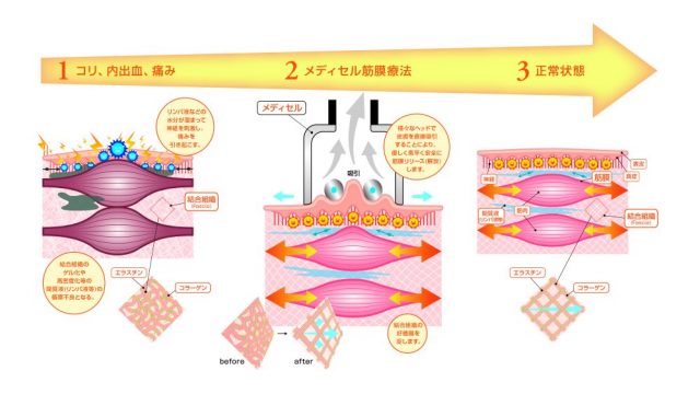 皮膚を吸引して結合組織の循環を促す、メディセル筋膜療法