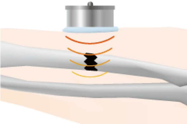 LIPUSによる音圧効果で骨の形成を促進し治療期間を約40%短縮 / LIPUS