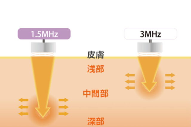 深部から浅部まで適切に対応する1.5MHz・3MHzプローブ / LIPUS