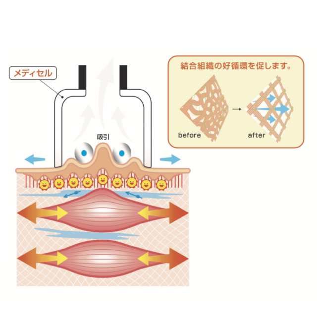 メディセル療法