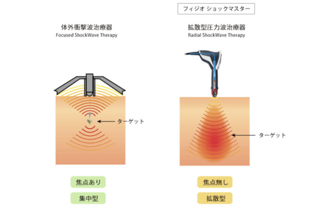 体外衝撃波治療器とショックマスターの違い（1）